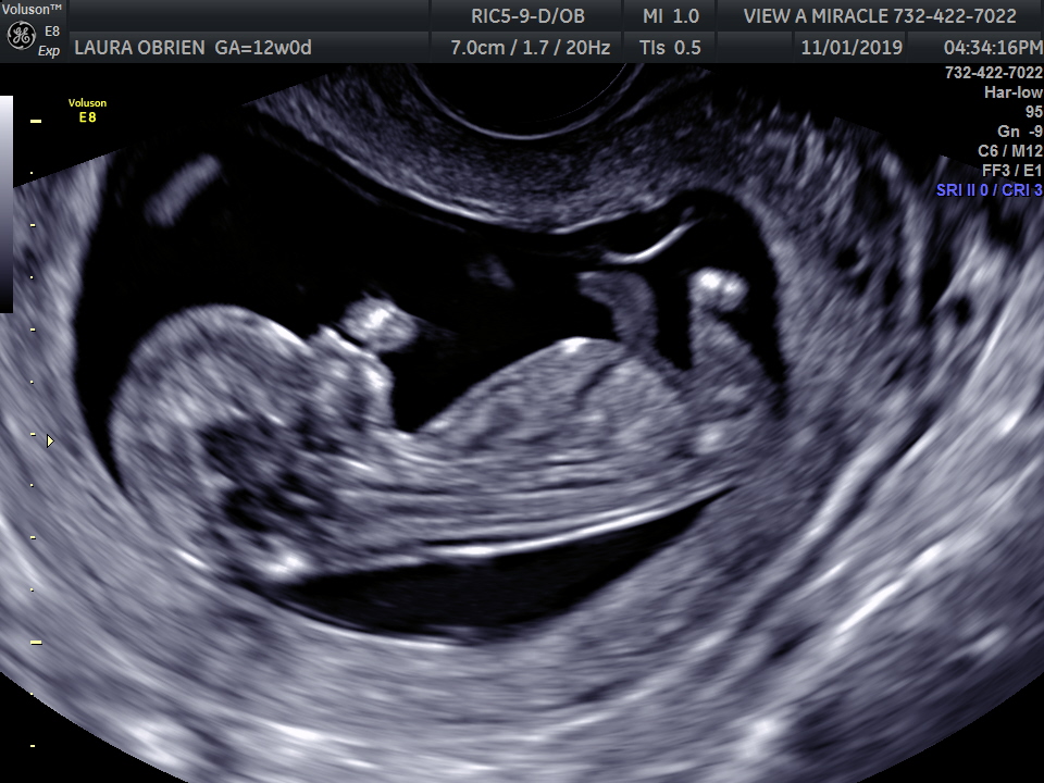 What_Can_You_See_on_16-Week_Ultrasound